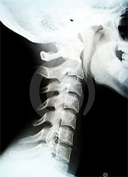 X-ray of cervical spine